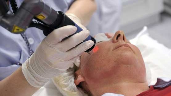 Potilaan ihoon tehdään reikiä laservalolla.