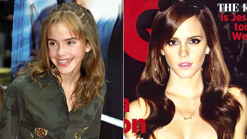 Emma Watson kymmenen vuotta sitten ja nyt.