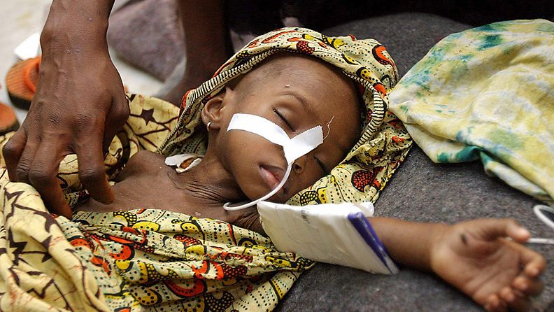 Liberialainen Edith Gboea oli hoidettavana Lääkärit ilman rajoja -järjestön klinikalla Liberian pääkaupungissa Monroviassa 28.7.2003. Gboea kärsi malariasta,hengitystieinfektiosta ja aliravitsemuksesta.