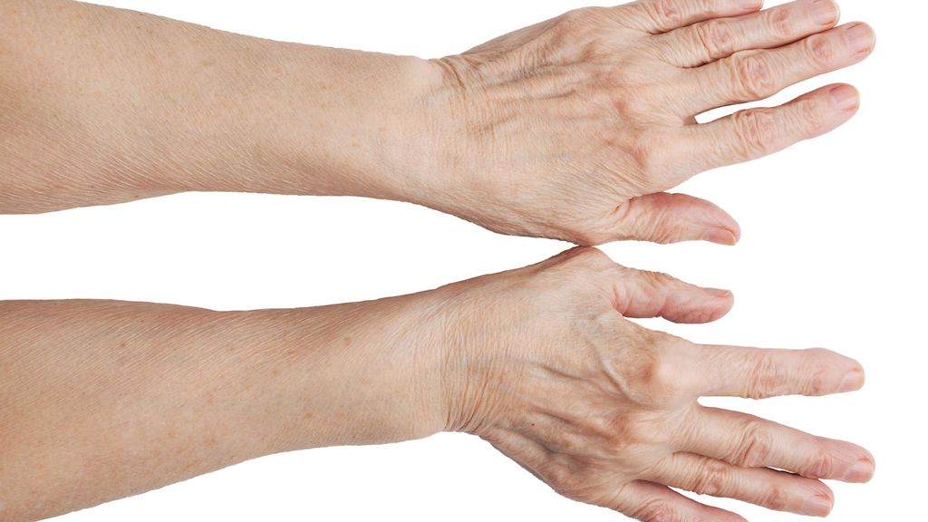 Расслабленные пальцы рук. Ревматоидный артрит запястного сустава. Артрит лучезапястного сустава. Шишка на суставе большого пальца.