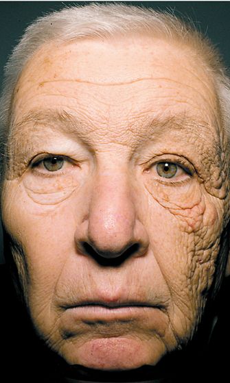 UV-säteily vanhentaa ihoa.