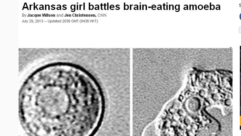 Yhdysvalloissa 12-vuotiaalla tytöllä on todettu harvinainen ja yleensä tappava loistartunta. Kuvakaappaus CNN:N sivuilta.
