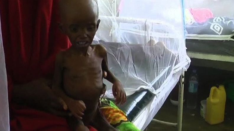 Nälänhädästä kärsiviä lapsia uhkaa nyt kolera Somaliassa.