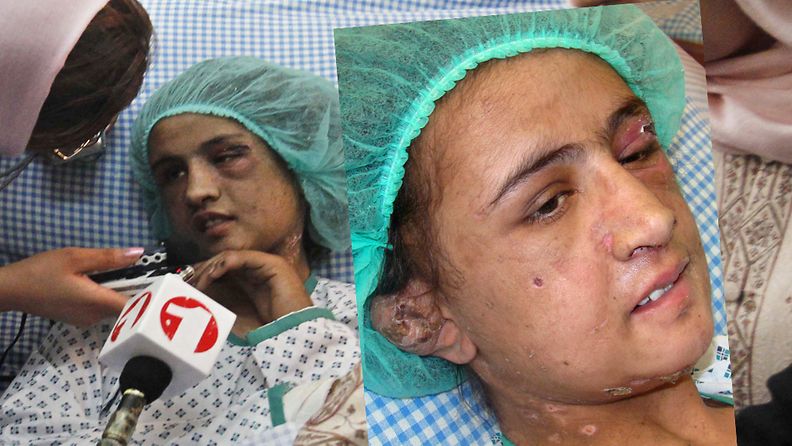 14-vuotiaana naitettu Sahar Gul kieltäytyi miehensä perheen vaatimuksista ryhtyä prostituoiduksi. Tämän jälkeen perhe pahoinpiteli häntä julmasti. Alkuperäiskuvat: EPA; kuvankäsittely MTV3. 