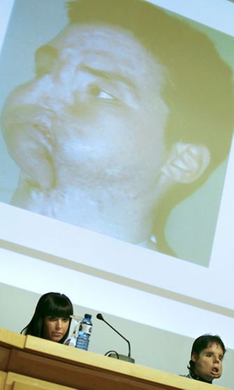 Maailman ensimmäisen täydellisen kasvojensiirron läpikäynyt mies, espanjalainen Oscar, astui julkisuuteen 26.7.2010. (Kuva: EPA)