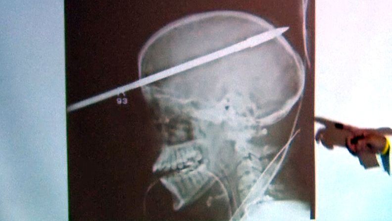 Röntgenkuvista näkyy kuinka harppuunan nuoli lävisti teinipojan pään. 