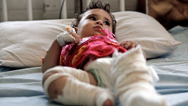 18 kuukautta vanha Raiga Waghan sai hoitoa vammoihinsa Al-Shifan sairaalassa Gazassa 6. elokuuta 2014. 