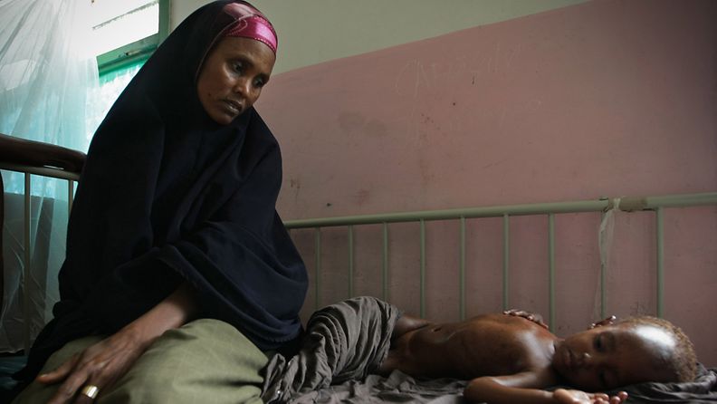 Äiti hoitaa nestevajauksesta ja aliravitsemuksesta kärsivää lastaan Somalian pääkaupungissa Mogadishussa. Kuva: EPA