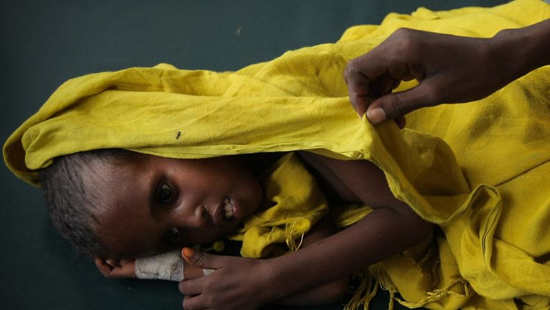 Aliravitsemuksesta pahasti kärsivä lapsi Somalian Mogadishussa. Kuva: EPA