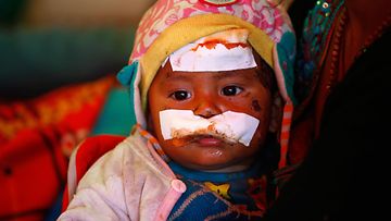 Elämä voittaa. Nepalin maanjäristyksessä vammoja päähänsä saanut lapsi oli loukkaantumisestaan huolimatta onnekas. Hän selvisi hengissä toisin kuin tuhannet maanmiehensä.