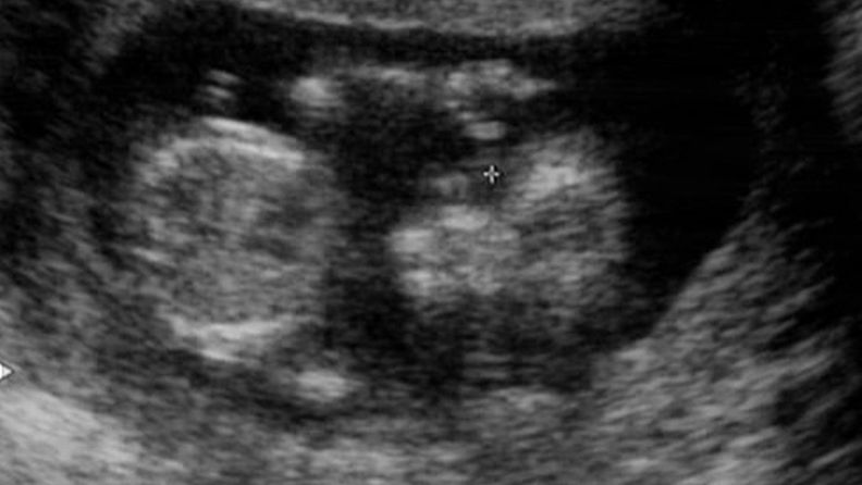 Ensimmäinen ultraääni.