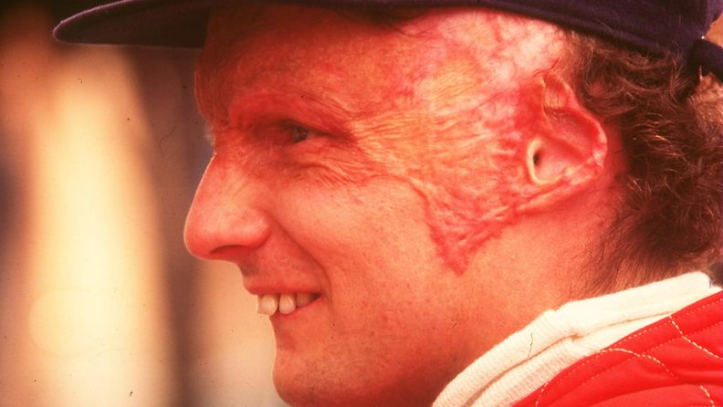 Niki Lauda 1976 onnettomuuden jälkeen.