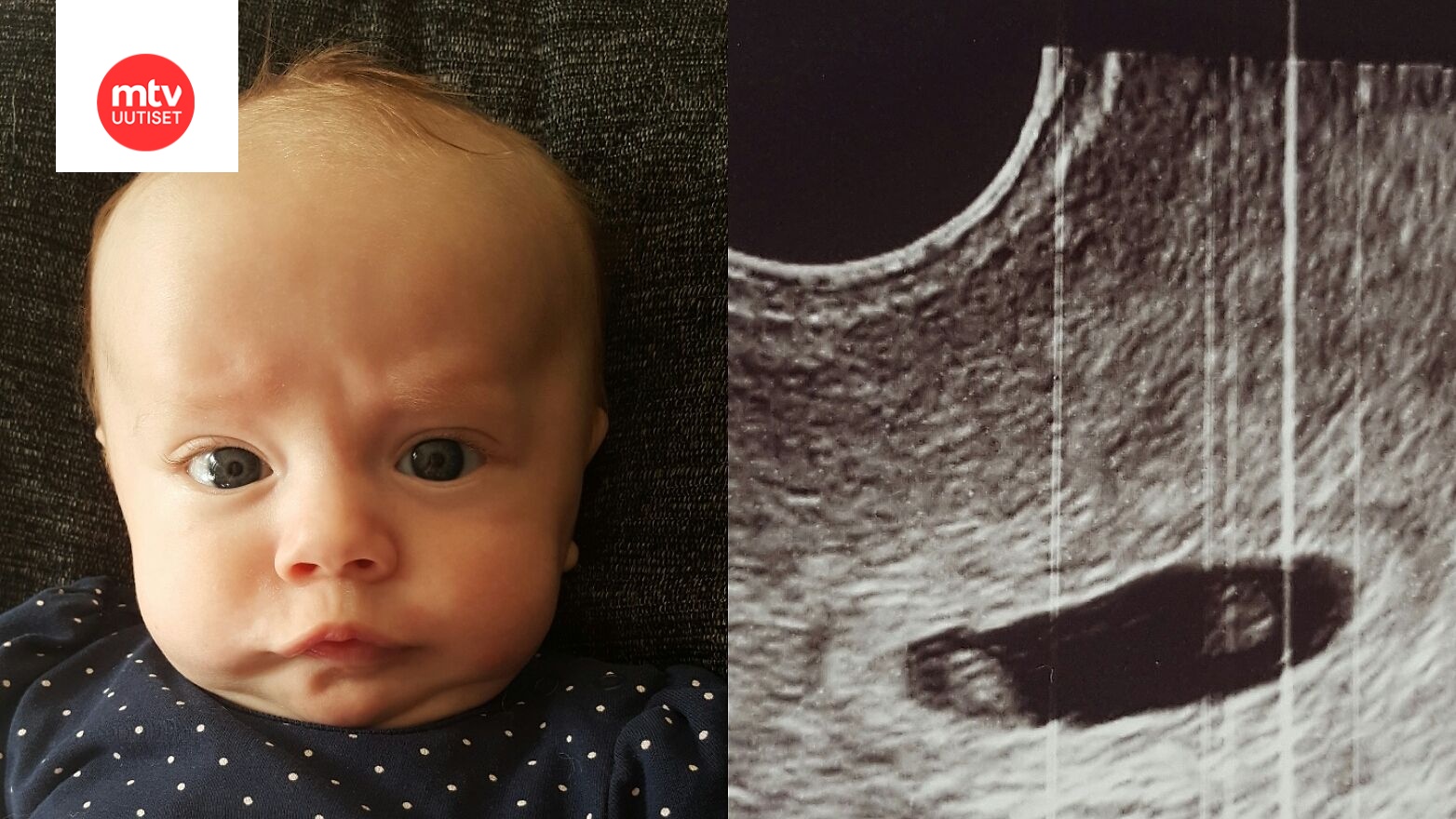 Tammikuussa esikoisensa synnyttänyt Miia odottaa jo kaksosia: ”En vieläkään  meinaa uskoa sitä” 