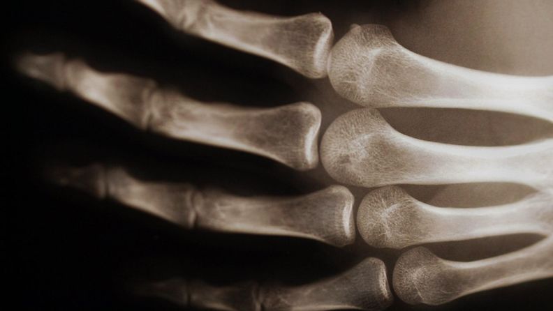 luuranko käsi röntgen