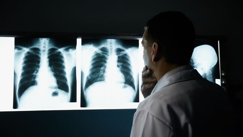 keuhkosyöpä seulonta