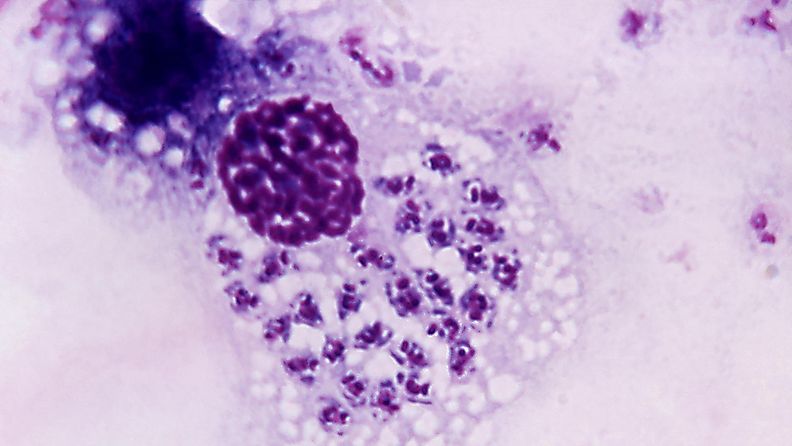 Trypanosoma cruzi, chagasin tauti