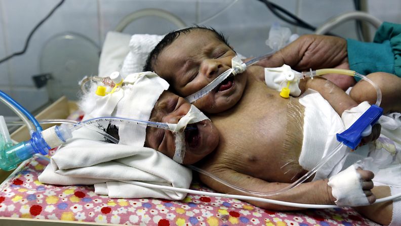 AOP Jemen vauvat kaksoset Sanaa 2