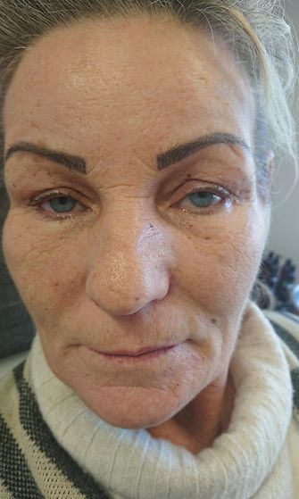 Botox-rikosepäily Vantaalla, epäilty 2