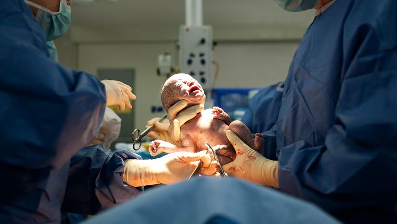 aop keisarileikkaus, sektio, synnytys, vastasyntynyt vauva