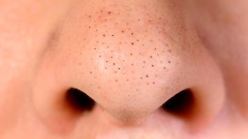 Blackheads are simply clogged pores. Illustration image. Copyright: Shutterstock. Photographer: Nau Nau . shutterstock_1166574379