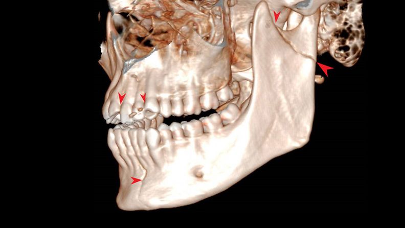 Sähköpotkulaudalla onnettomuuteen joutunut potilas antoi luvan käyttää kuvaansa artikkelissa. Tähän kuvaan on merkitty onnettomuuden aiheuttamat murtumakohdat ja hammasvammakohdat. Kontrastia on myös hieman lisätty näkyvyyden parantamiseksi. 