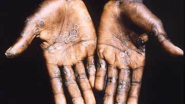 Kuvassa ihmisen kädet, jossa näkyy apinarokon aiheuttamia vesikelloja.