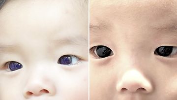 Koronalääke muutti vauvan silmien väriä
