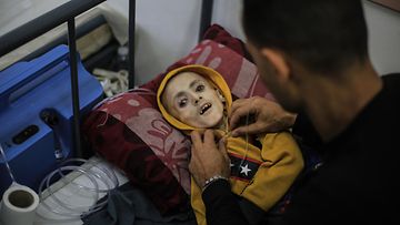 10-vuotiasta Yazan Al-Kafarnehia hoidetaan lastensairaalassa Rafahissa 2. maaliskuuta 2024. Yazan kuoli aliravitsemukseen pari päivää kuvan ottamisen jälkeen.