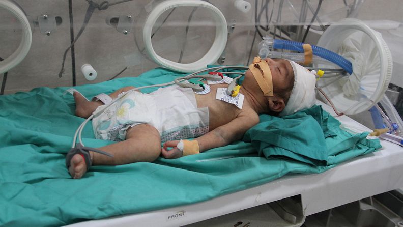 Aliravitsemuksen takia sairaalahoitoon joutunut vauva Kamal Adwanin sairaalassa Beit Lahiassa 2. maaliskuuta 2024.